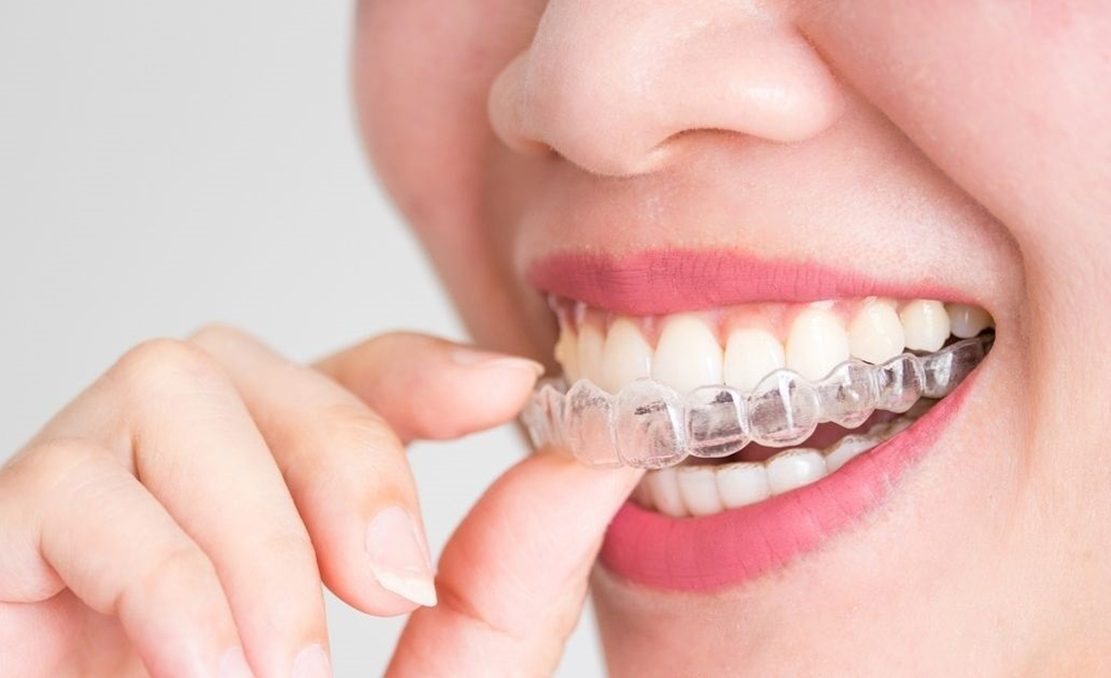 Quanto custa o Invisalign em Alphaville? Descubra o que influencia no valor